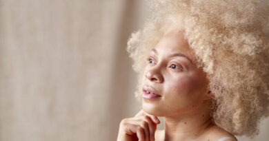 Albinism Awareness Month puts overlooked skin cancer risks in focus